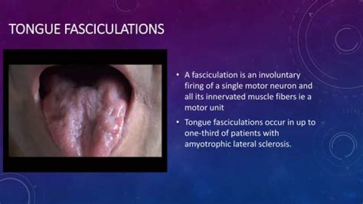 Are Fasciculations the first sign of ALS?