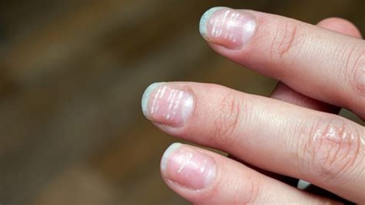 Are white spots on nails a sign of calcium deficiency?