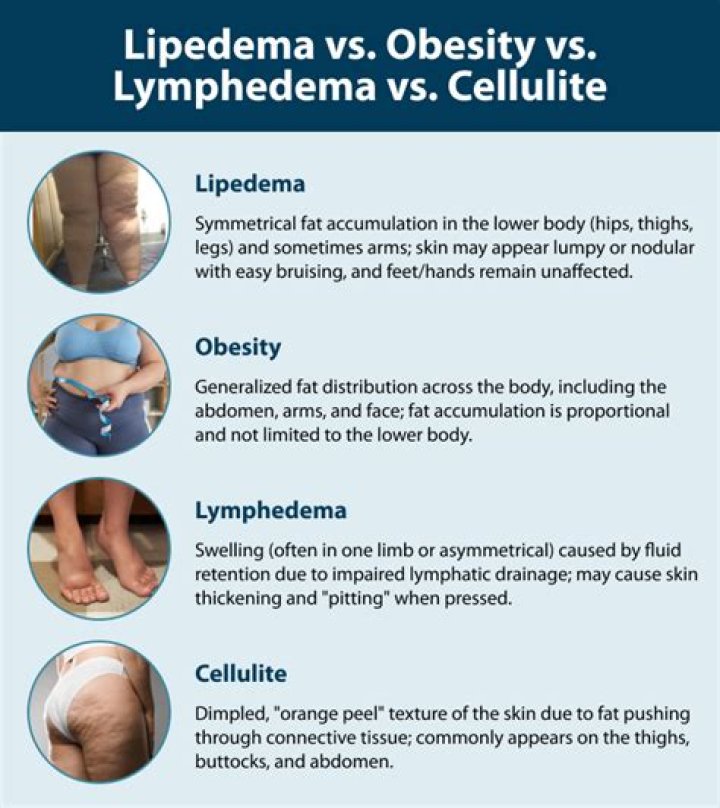 Can obesity cause pitting edema?