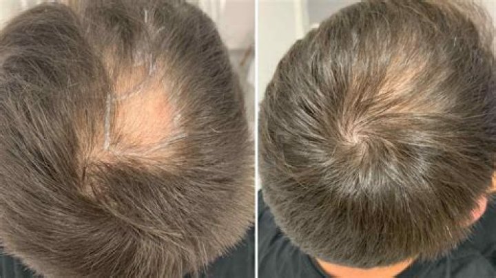 Does being put to sleep cause hair loss?