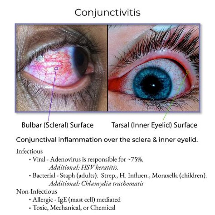 How long is viral conjunctivitis contagious?