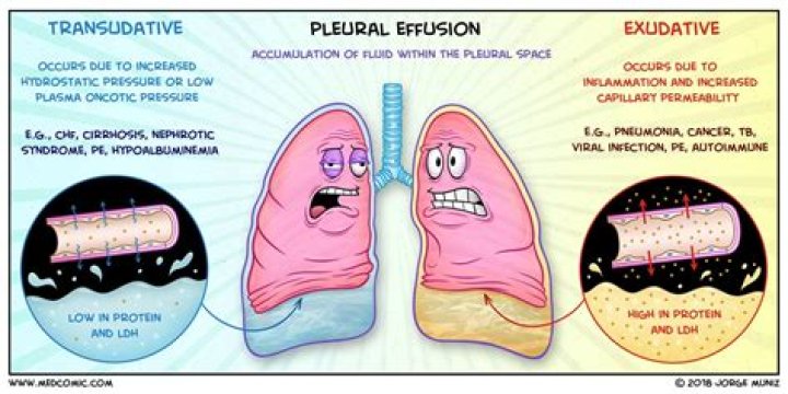 What causes fluid in lungs?