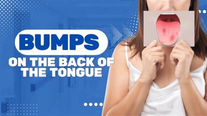 What causes lie bumps on my tongue?