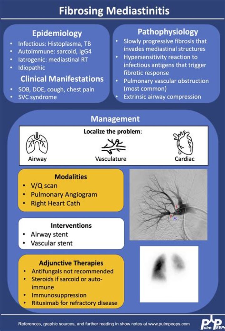 What is fibrosing mediastinitis? | ContextResponse.com
