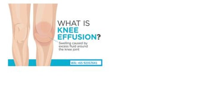 What is the meaning of knee joint effusion?