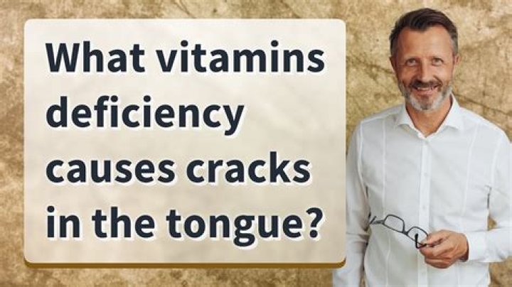 What vitamin deficiency causes cracks on side of mouth?
