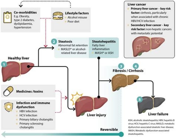 Why does liver disease cause fluid retention?